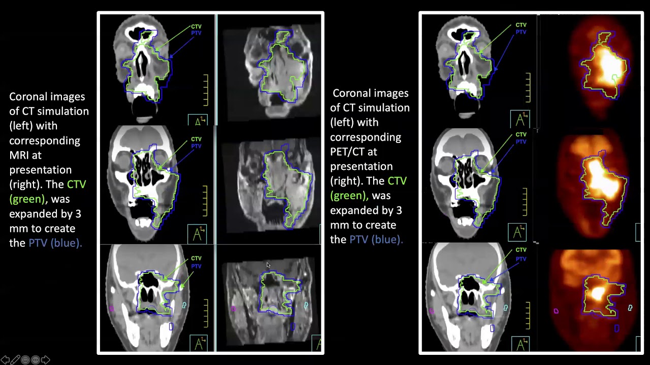 Dr. Bouthaina Dabaja: Radiation Therapy for NK/T-cell Lymphoma