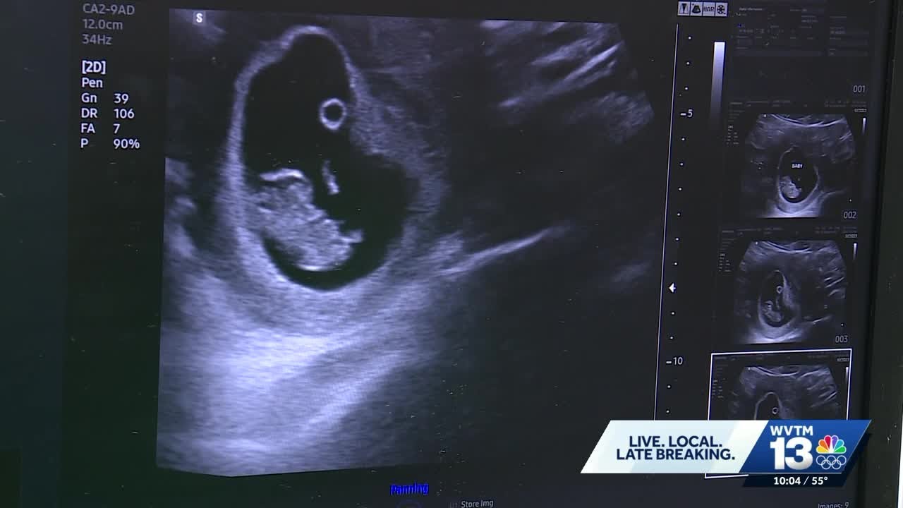 Alabama's robotic ultrasound plan raises concerns from OB-GYNs