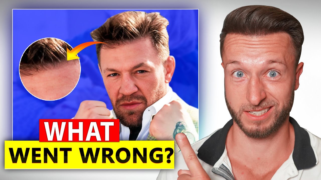 Failed Hair Transplant of Conor Mcgregor - 3 Years Later...