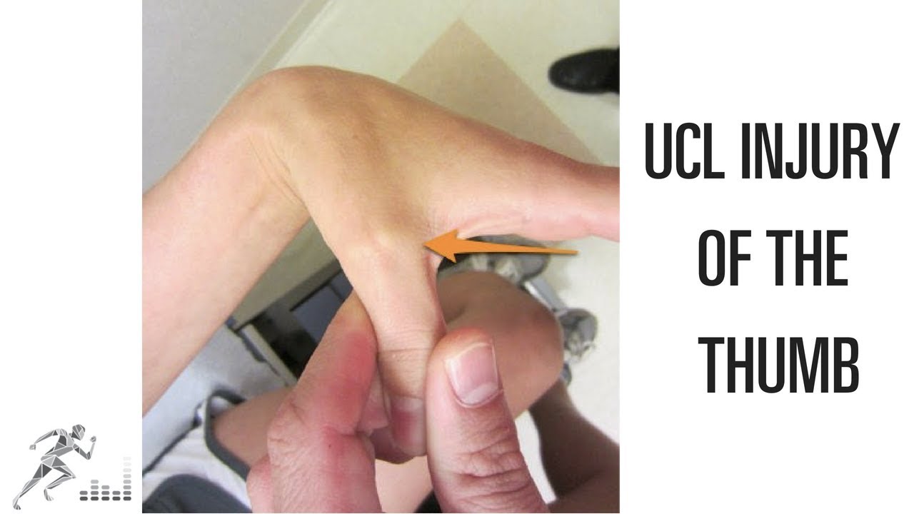 Повреждение UCL большого пальца кисти: механизм травмы и варианты лечения