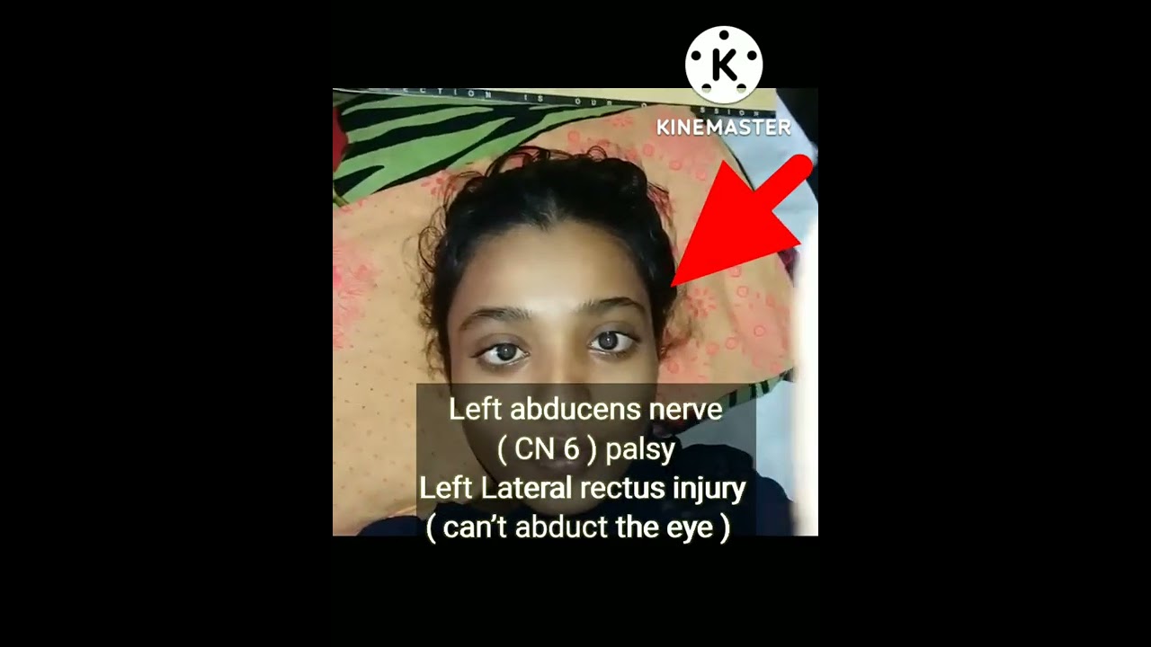 Left abducens nerve ( CN 6 ) palsy
