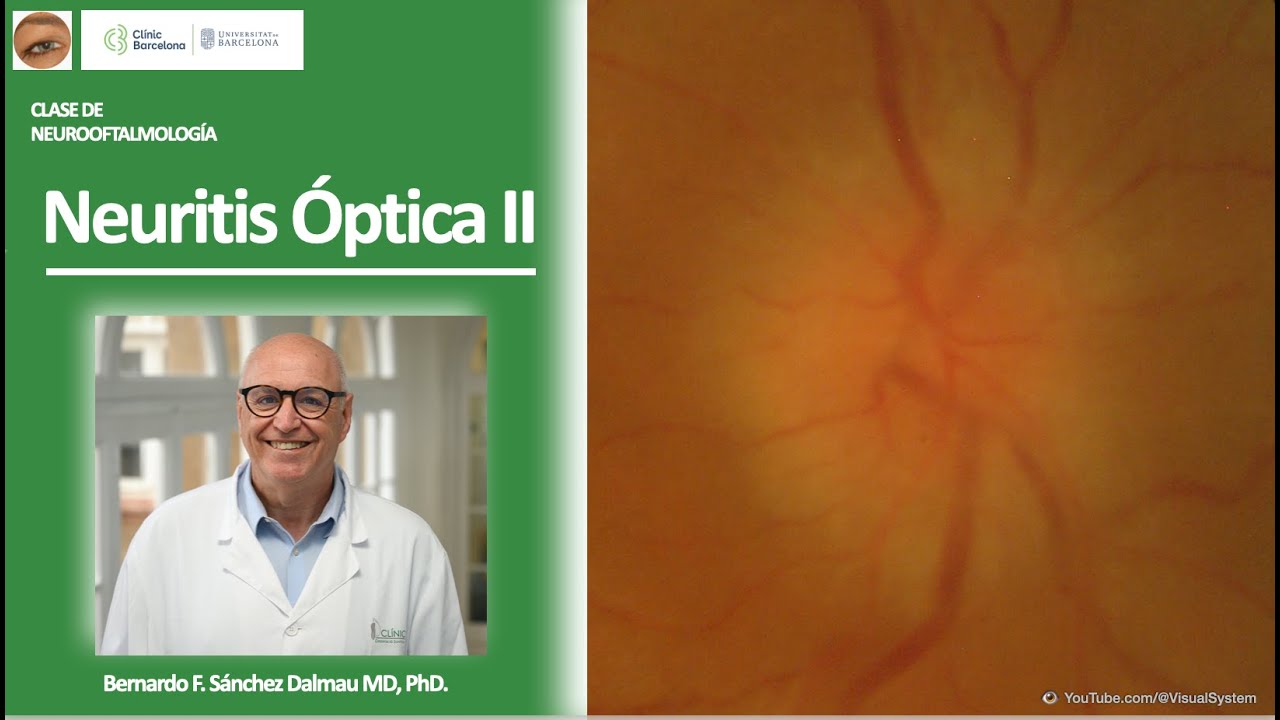 Neuritis Óptica II. Clase de NeuroOftalmología. #opticneuritis #neuro