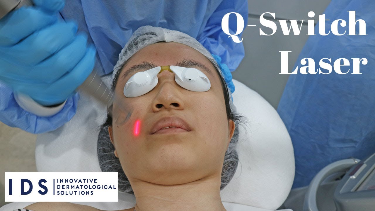 Q Switch Laser Before and After | IDS Clinic Review