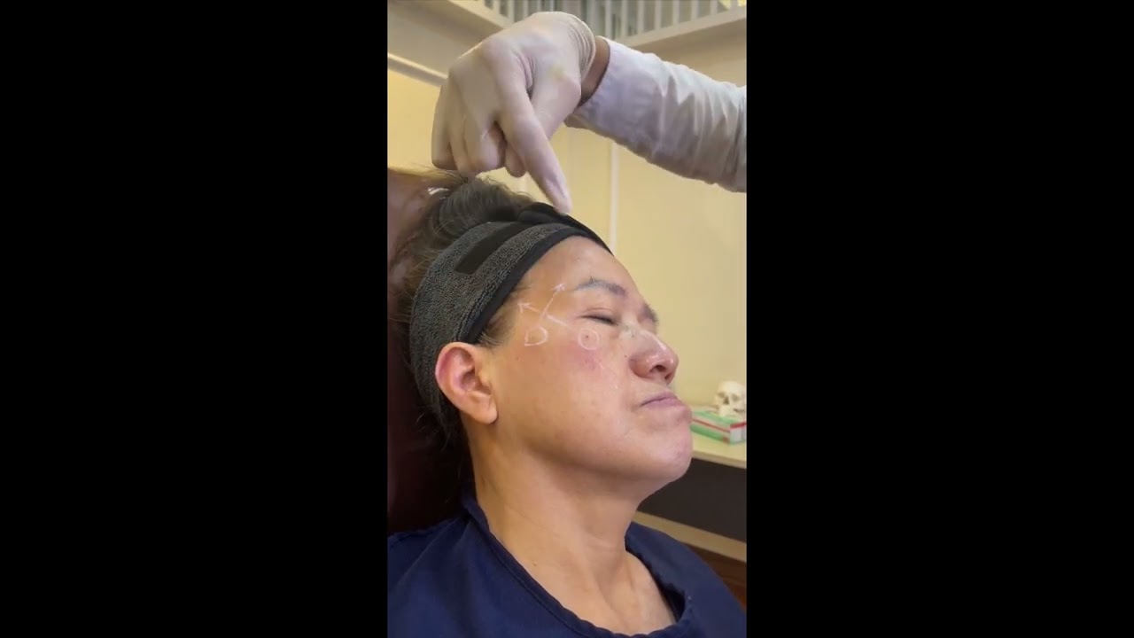 Temporal Filler Interfascial Plane Cannula Technique Dr.Art