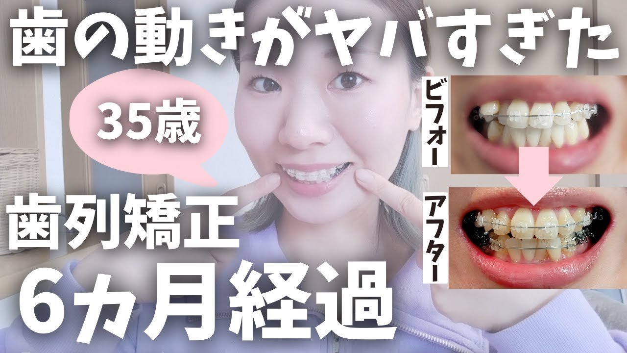 【歯列矯正】半年経過のビフォーアフターがヤバい！消えた八重歯！【表側ワイヤー矯正】
