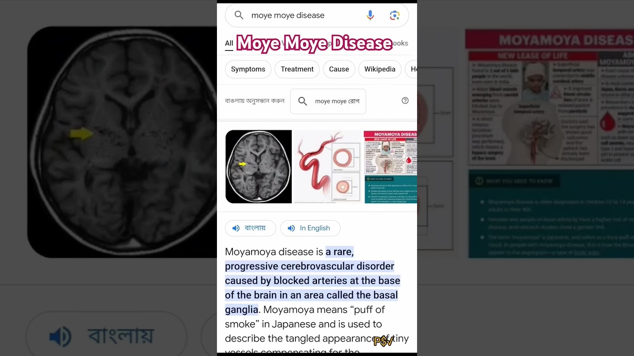 Moye Moye Disease। Moye Moye Syndrome ।