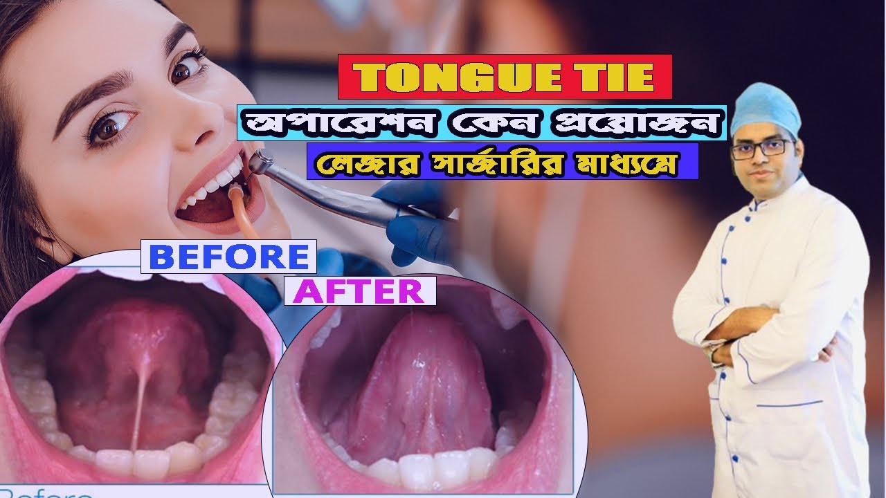 Tongue Tie অপারেশন কীভাবে করা হয় | প্রয়োজনীয়তা ও চিকিৎসা | Tongue tie laser surgery.