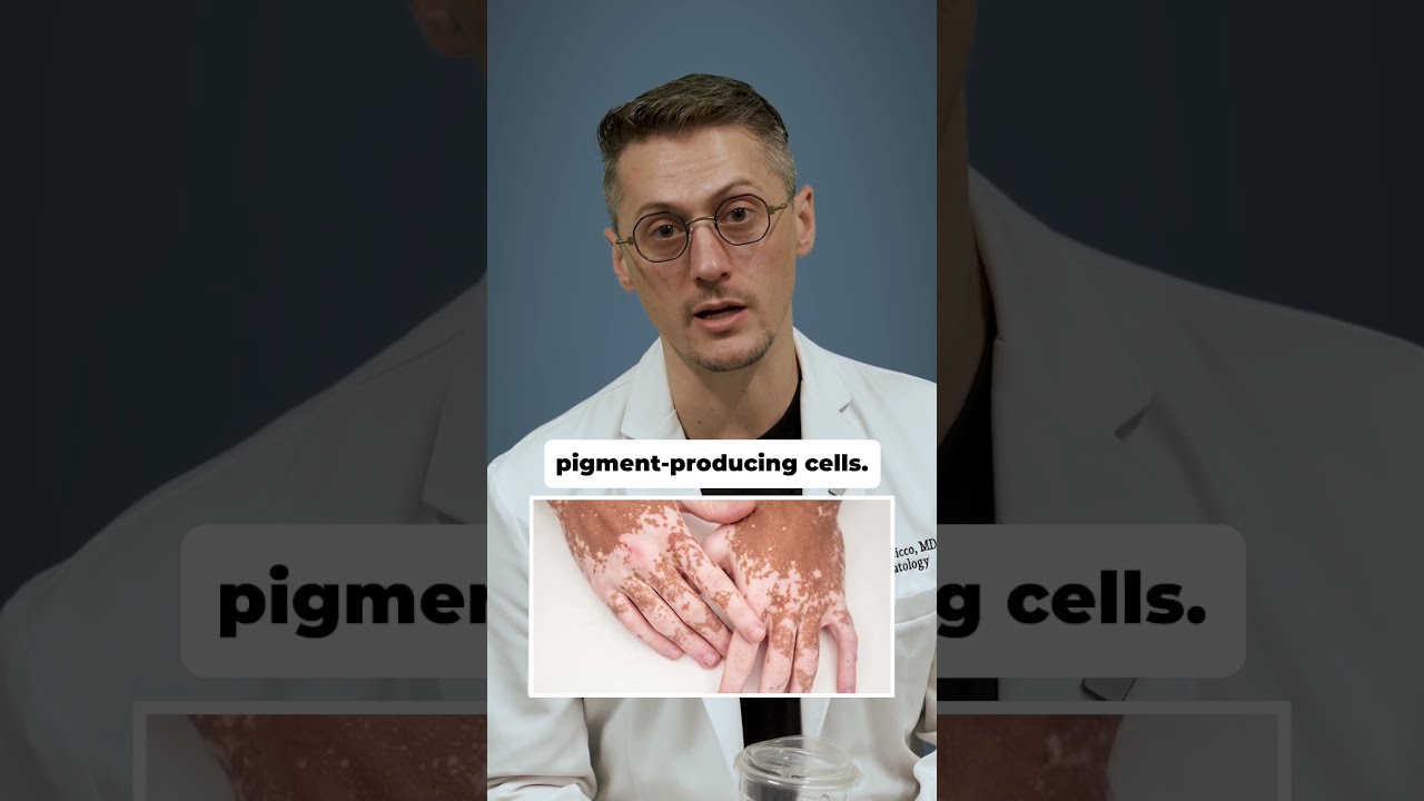 Is Vitiligo Contagious? Let's Clear It Up.