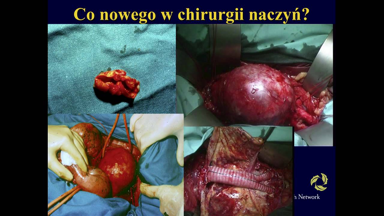 Sesja VI - Anestezjologia i chirurgia naczyń