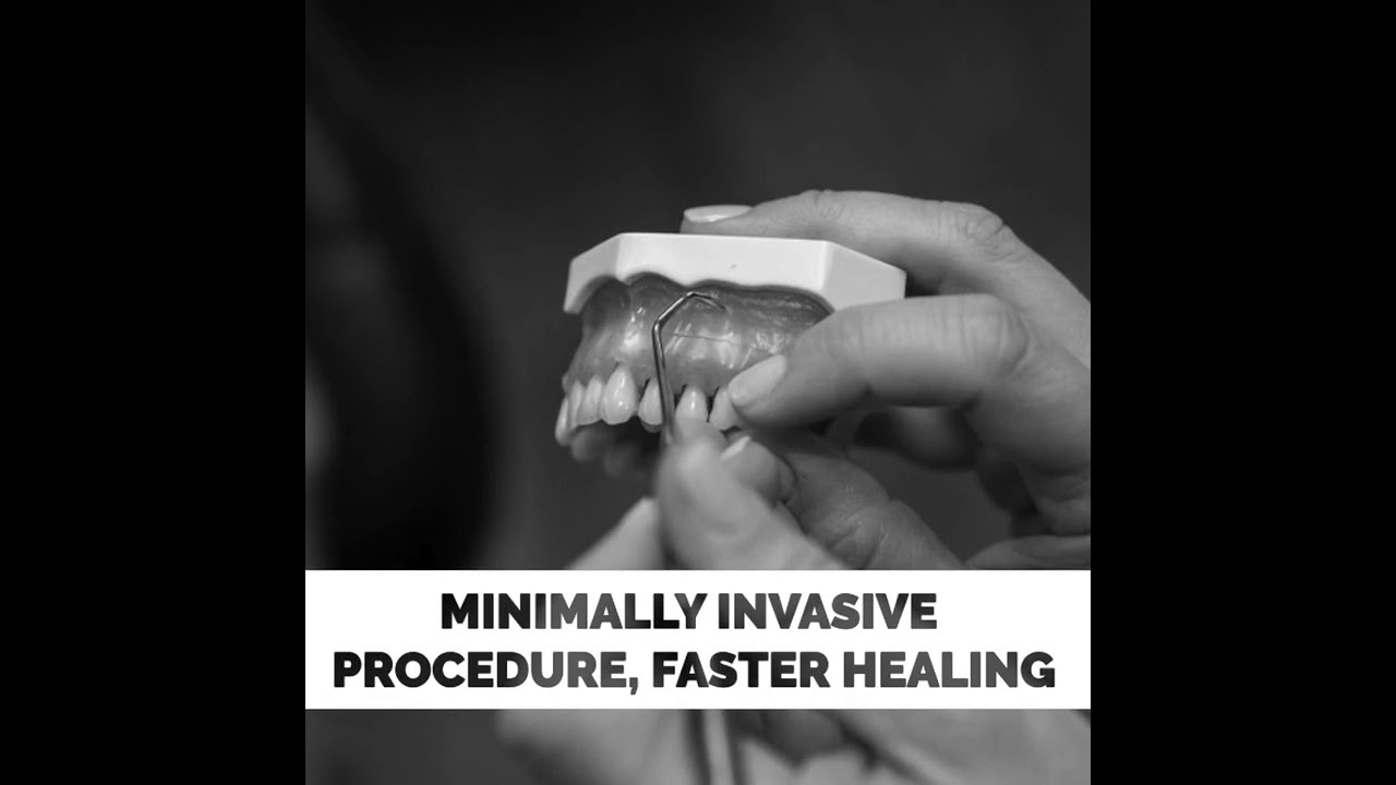 Pinhole Surgical Technique | Paradise Dental | Salem, MA