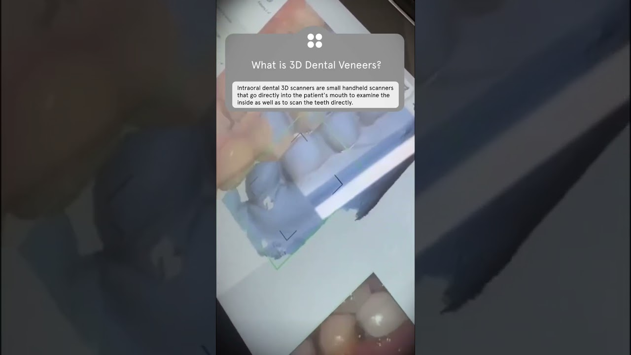 What is 3D Dental Veneers ? 