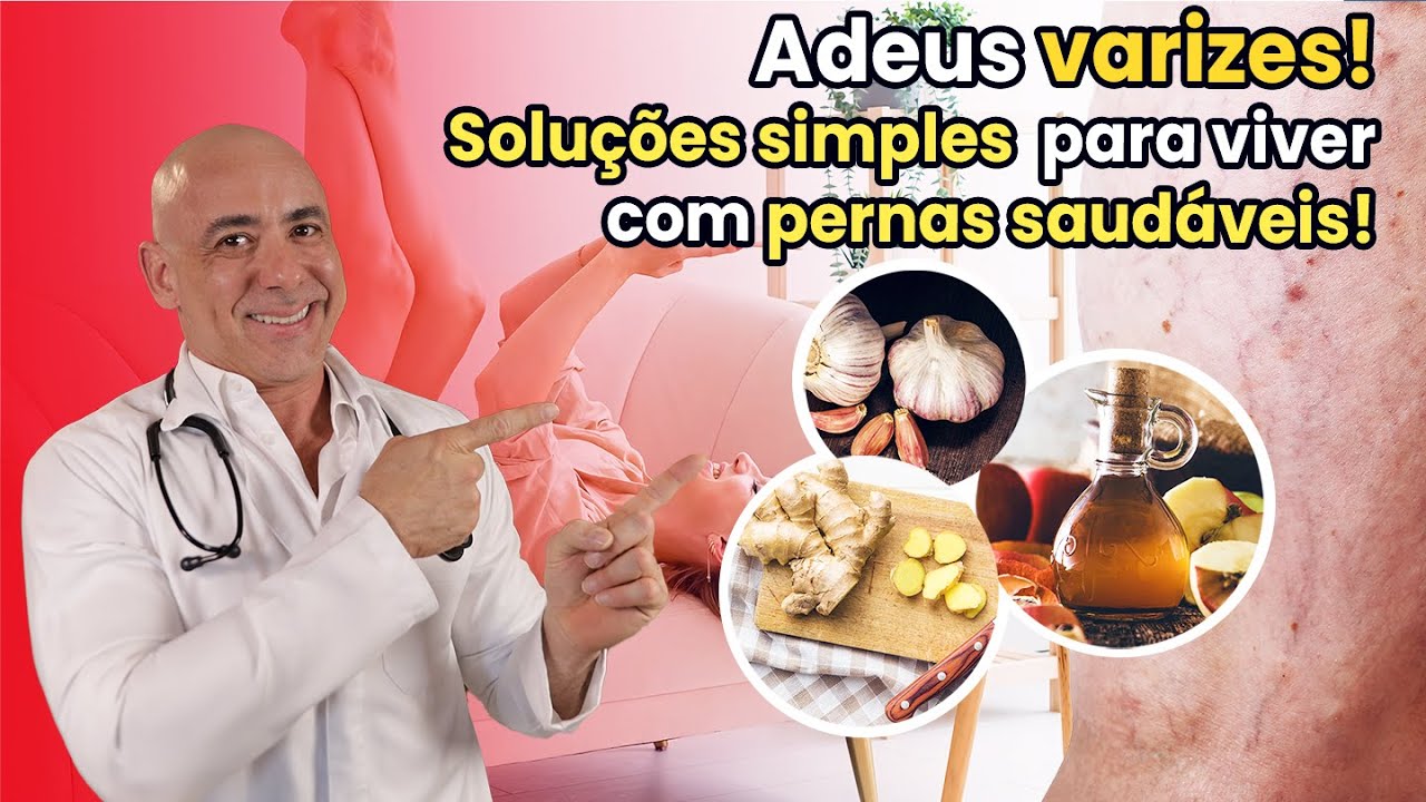 Adeus Varizes! Solu&ccedil;&otilde;es Simples para Viver com Pernas Saud&aacute;veis! | Dr Dayan Siebra