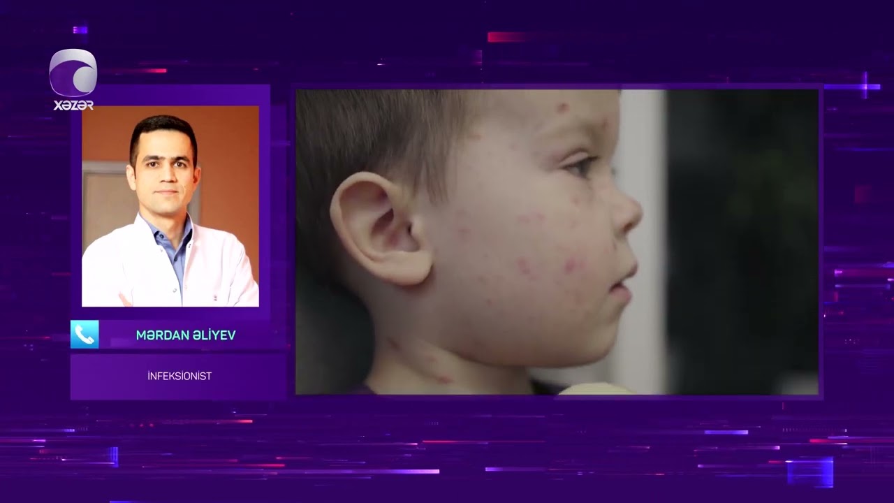 Uşaqlar arasında yayılan “parvovirus” virusu nədir?