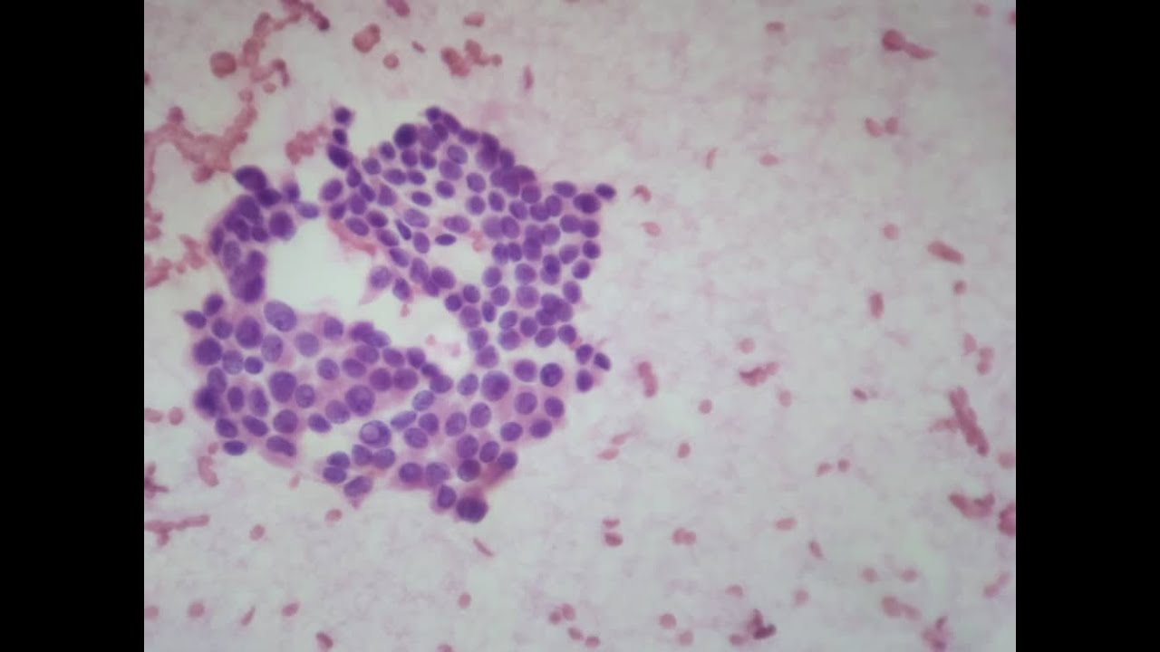 Carcinoma papilar de tiroides