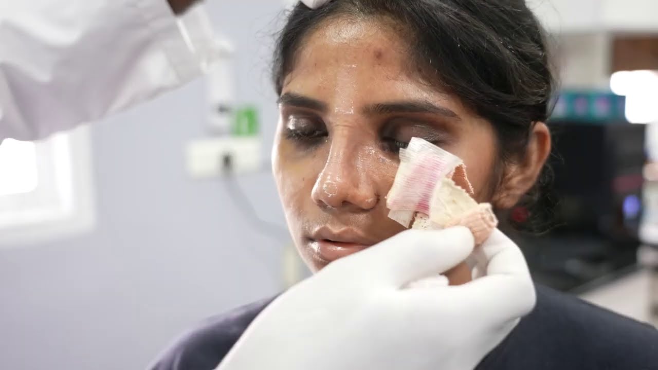 Rhinoplasty | Nose Job Before After Experience - India