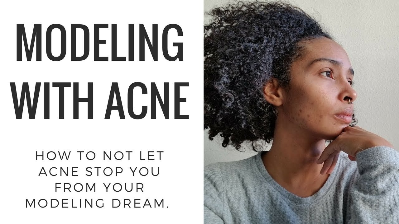 {REAL TALK} MODELING WITH ACNE