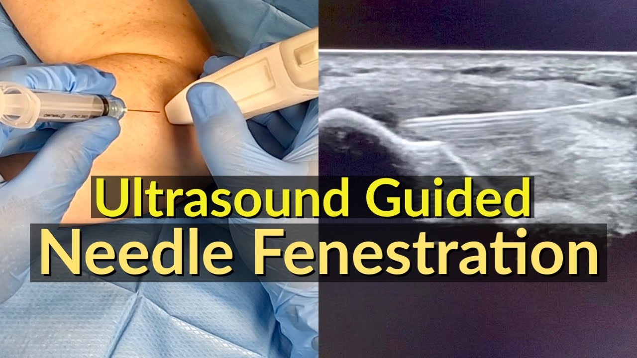 Ultrasound Guided Needle Fenestration / Dry Needling for Tennis Elbow