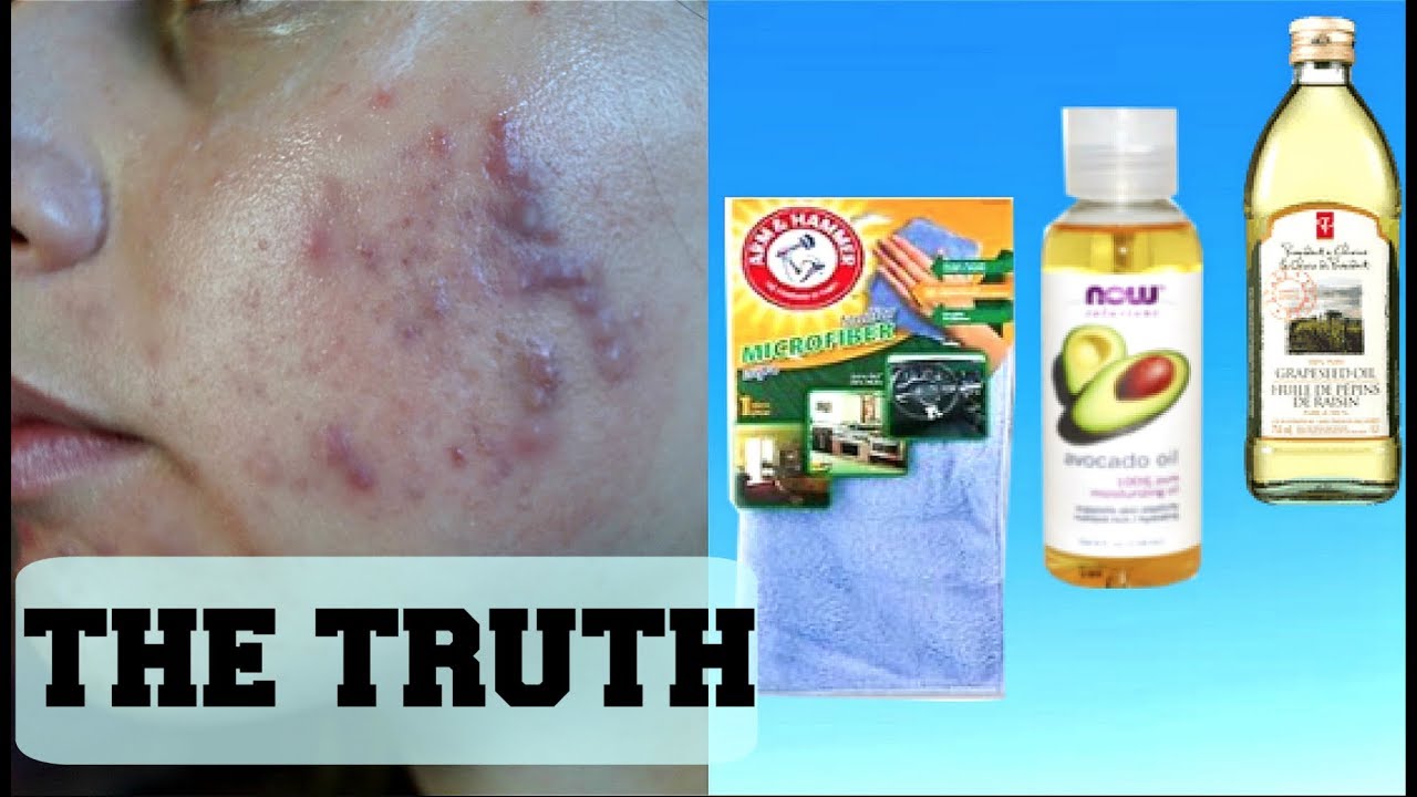I OIL CLEANSED FOR 2 WEEKS STRAIGHT|| THIS IS WHAT HAPPENED TO MY ACNE