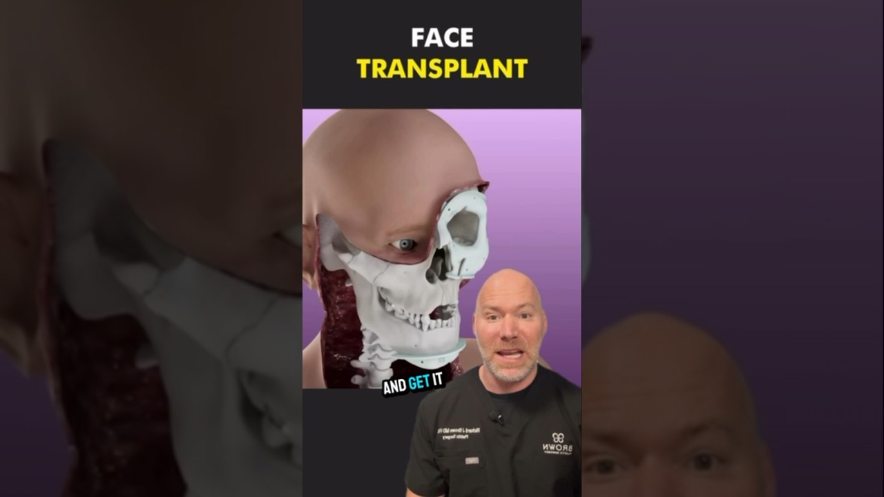 How Face Transplant Surgery Works? 🤯