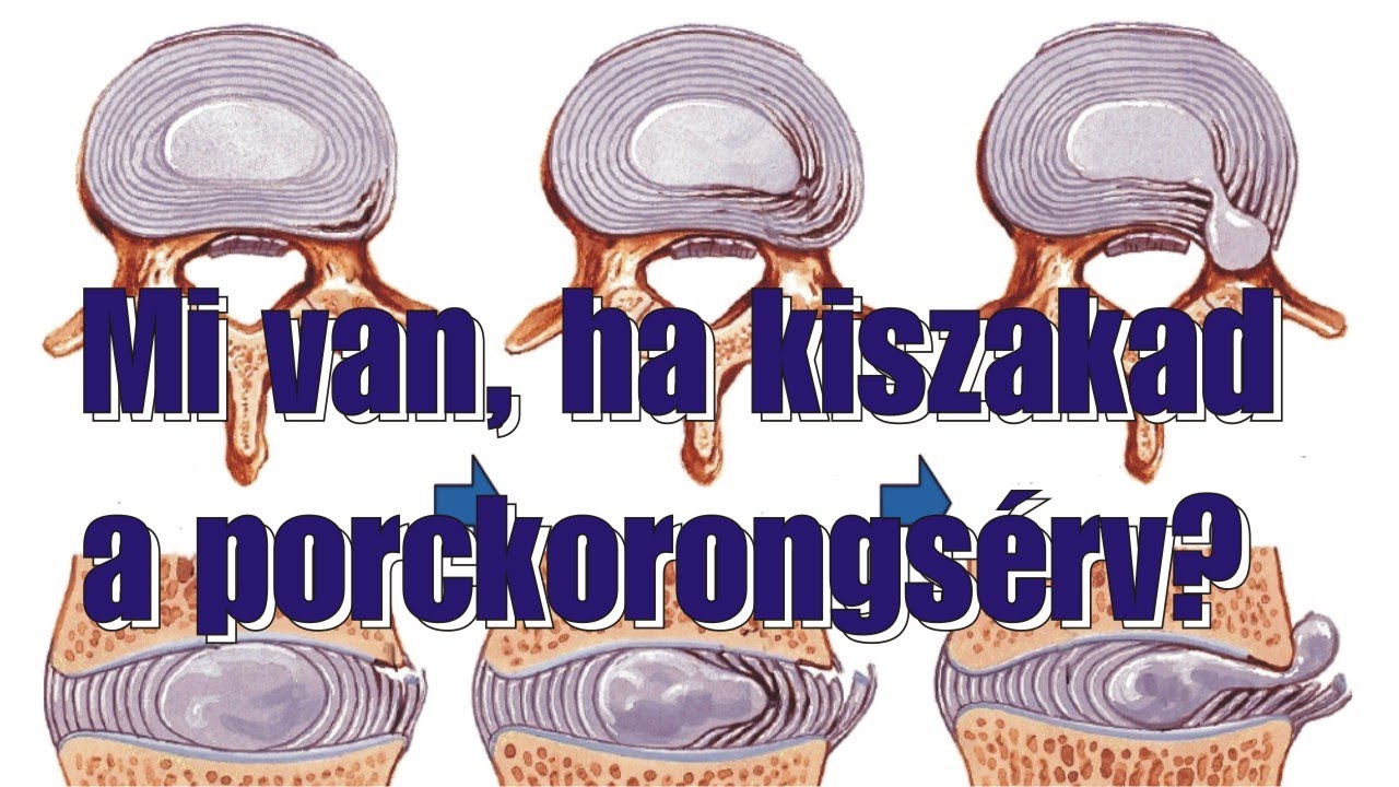 Mi van, ha kiszakad a porckorongsérv?