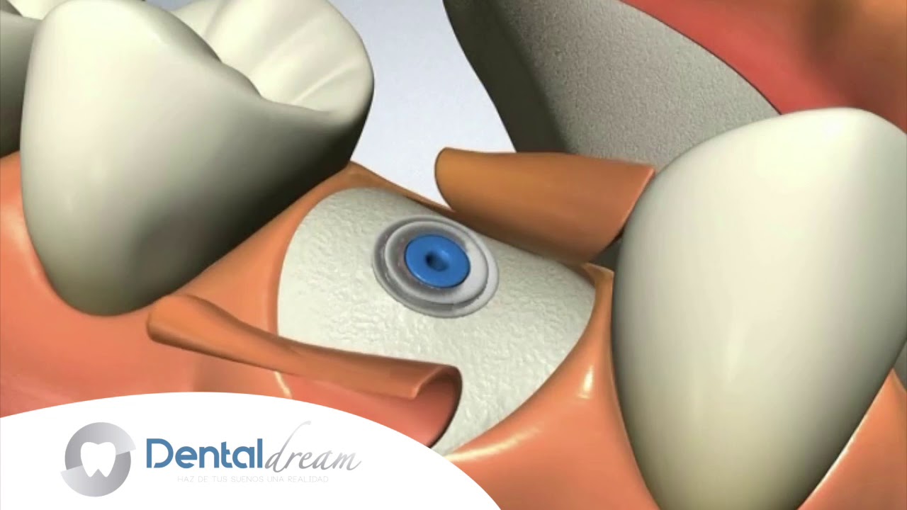 En Dental-Dream, colocamos Implantes Dentales