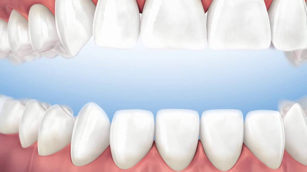 Como conservar el hueso cuando se hace una extracción dental