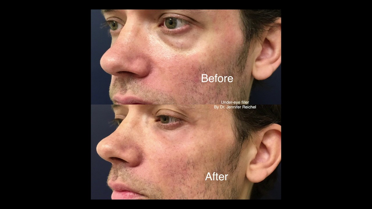 Under-Eye Filler for Men Using Belotero, Dr. Jennifer Reichel, Seattle & Renton