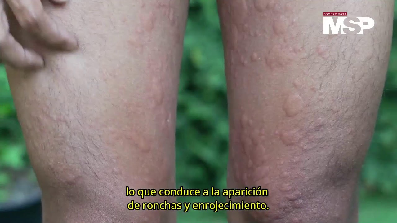 D&iacute;a Mundial de la Urticaria: &iquest;Qu&eacute; es y c&oacute;mo funciona? - #ExclusivoMSP