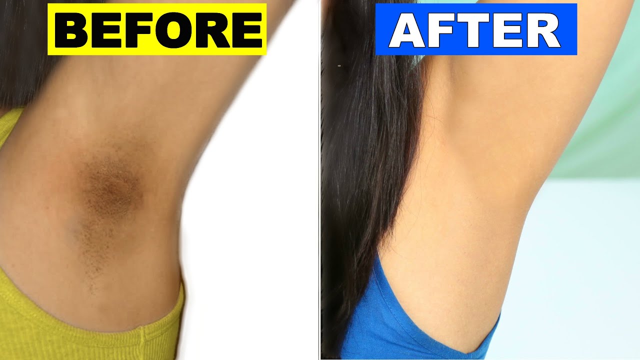 How To Lighten Dark Underarms Permanently | Skincare Routine | ShrutiArjunAnand