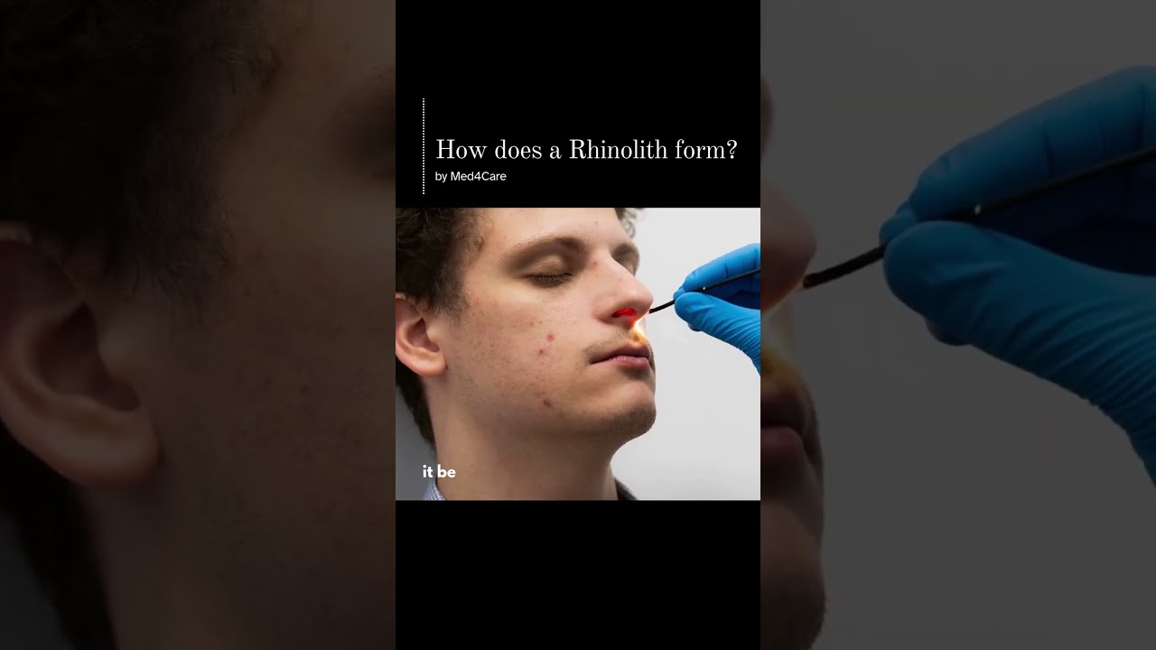How Does a Rhinolith Form