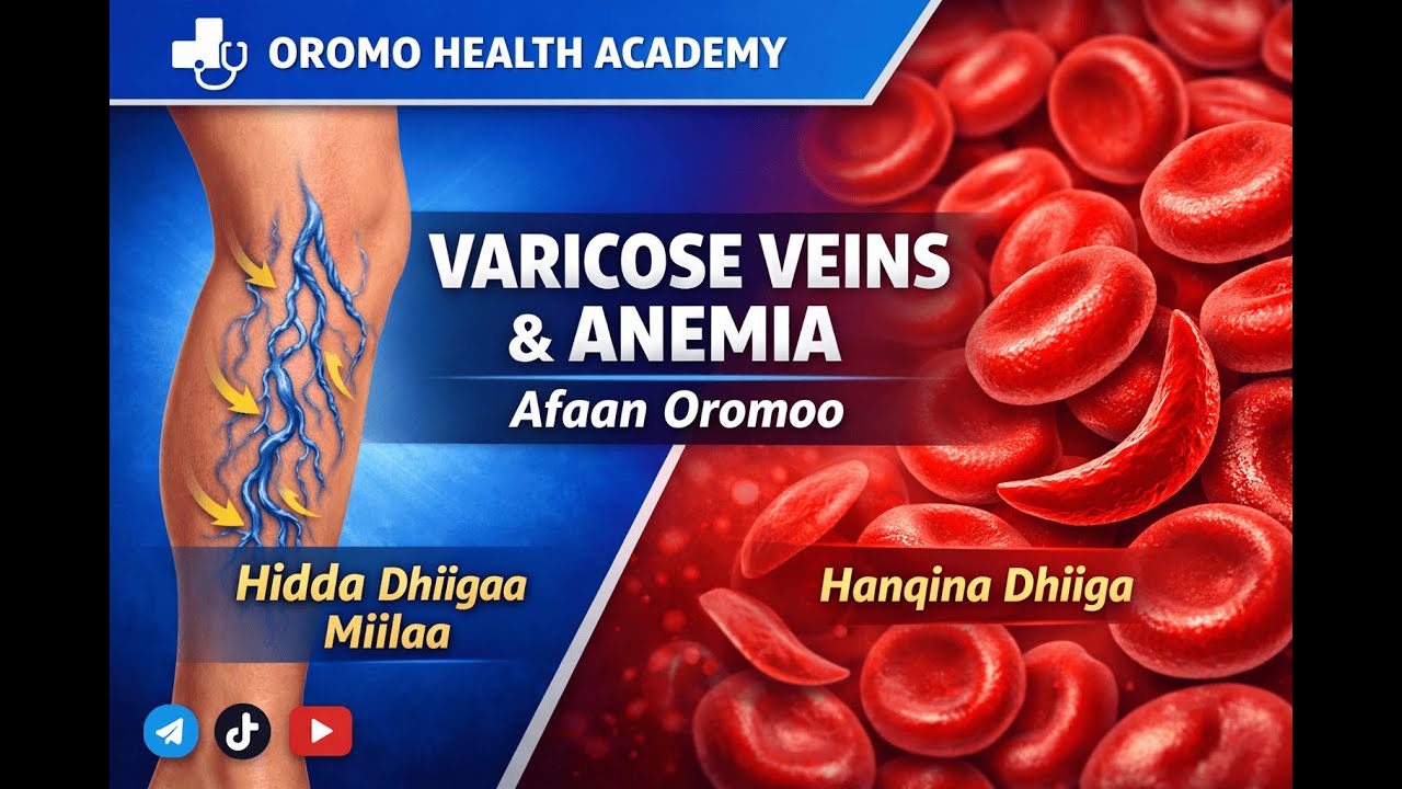 Varicose Veins & Anemia Explained: A Complete Medical Guide | Afan Oromo