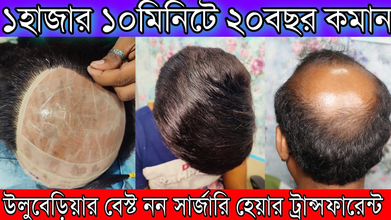 ১হাজার ১০মিনিটে ২০বছর বয়স কমান | উলুবেড়িয়ার বেস্ট নন সার্জারি হেয়ার ট্রান্সফারেন্ট