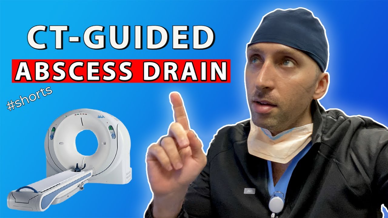 Emergent Abscess Drainage in under 30sec - Interventional Radiology