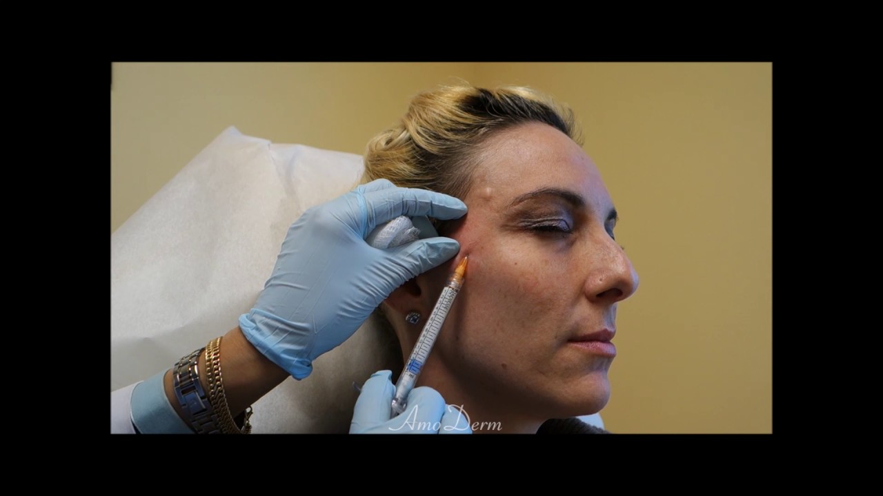 Temple Volume Restoration with Filler Injection