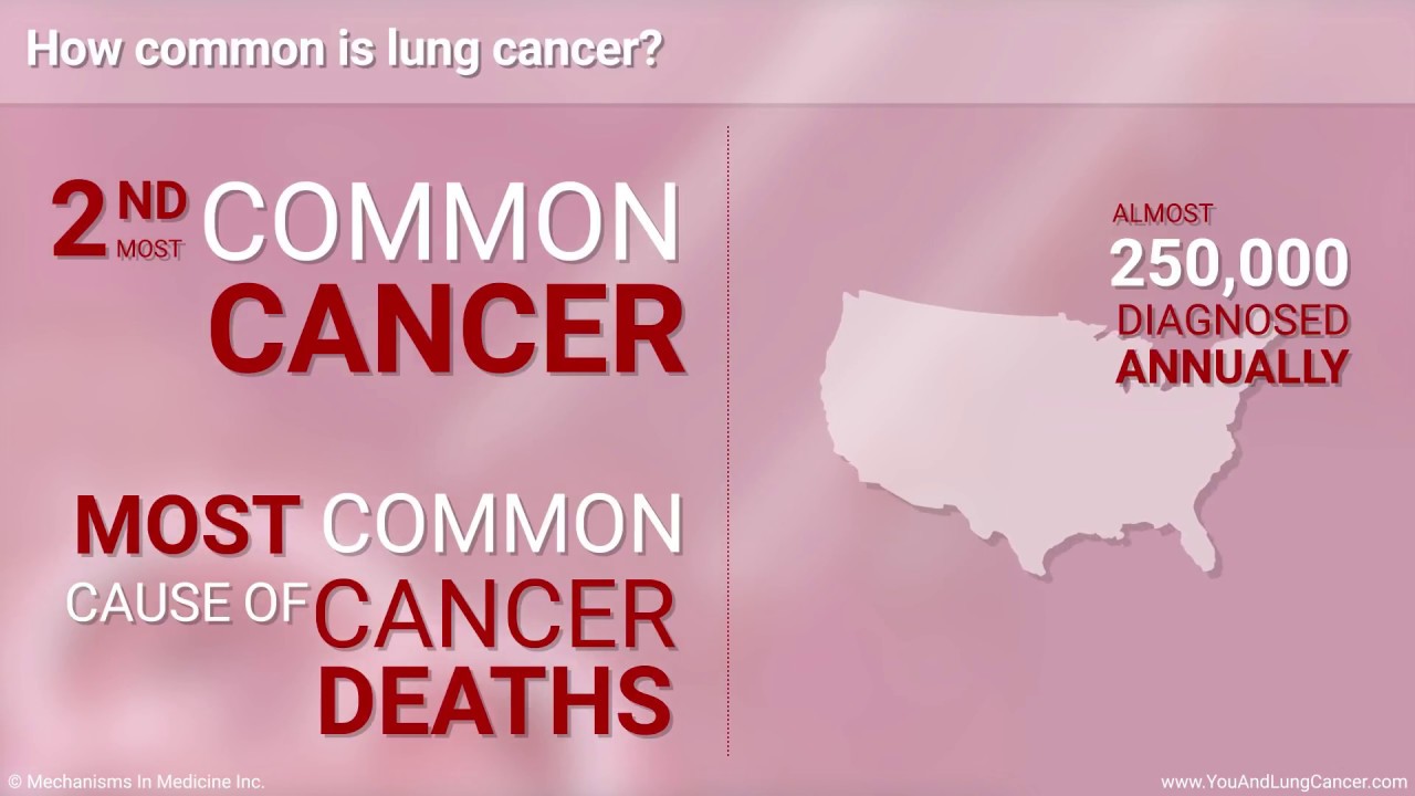 Understanding Small Cell Lung Cancer