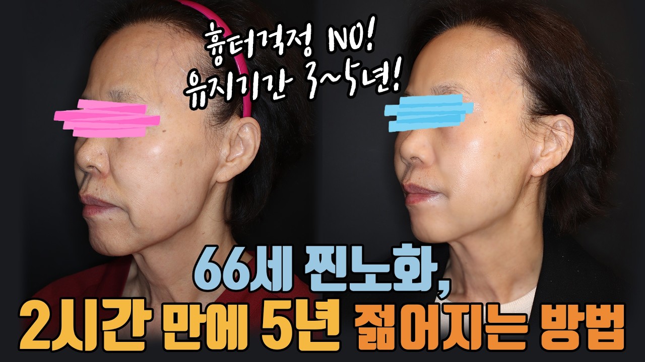 💧평생 시술 한 번 안 받던 66세 환자분이 '이것'을 선택한 이유? (feat. 리뉴비온)