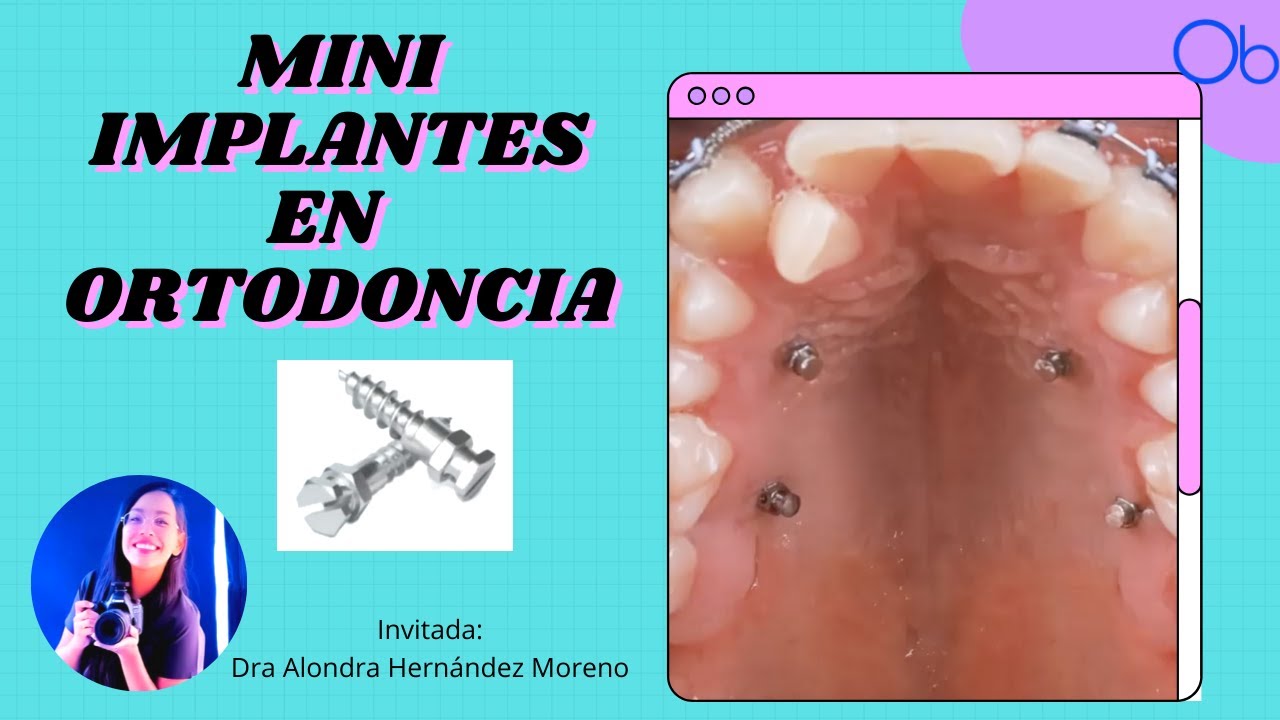 MINI IMPLANTES 🔩EN ORTODONCIA con Dra Alondra Hernández Moreno