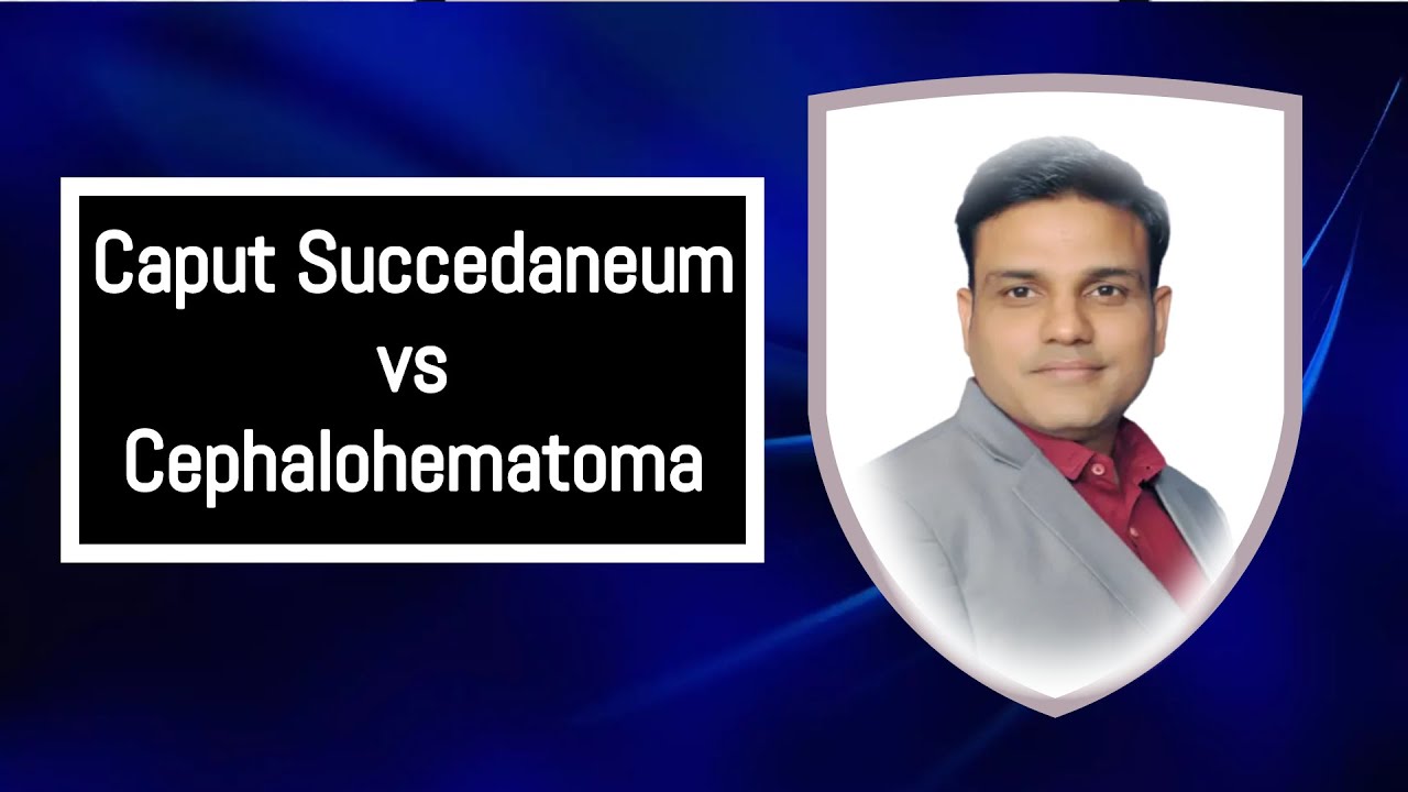 Caput Succedaneum v/s Cephalohematoma || NSG Studiz || Shailendra Sir