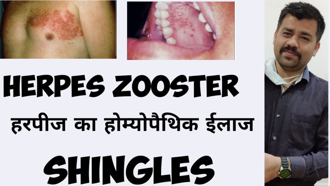 Herpes zooster homoeopathic treatment|हरपीज का होम्योपैथिक ईलाज