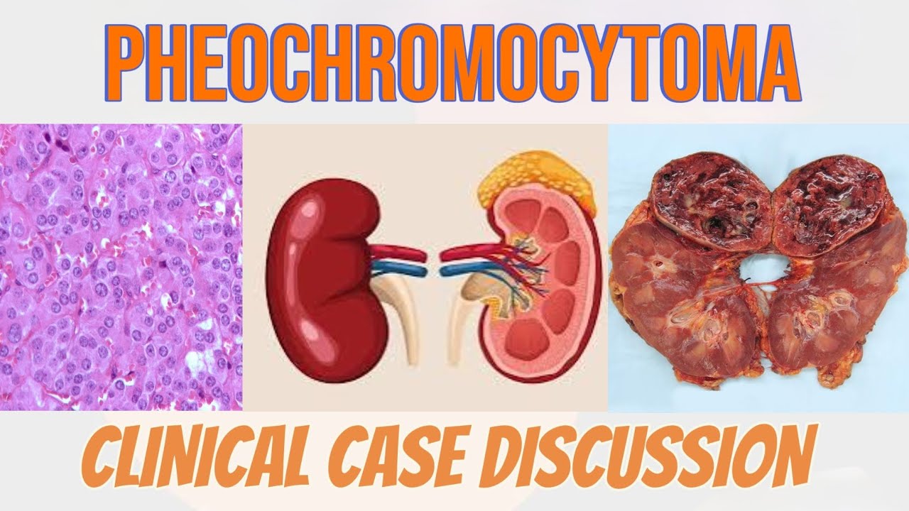 Pheochromocytoma|| USMLE || Case Discussion || High Yield ||