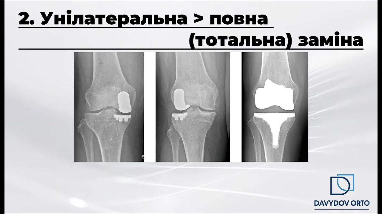 Що вам треба знати про #ендопротезування колінного суглоба? Відповідь у відео