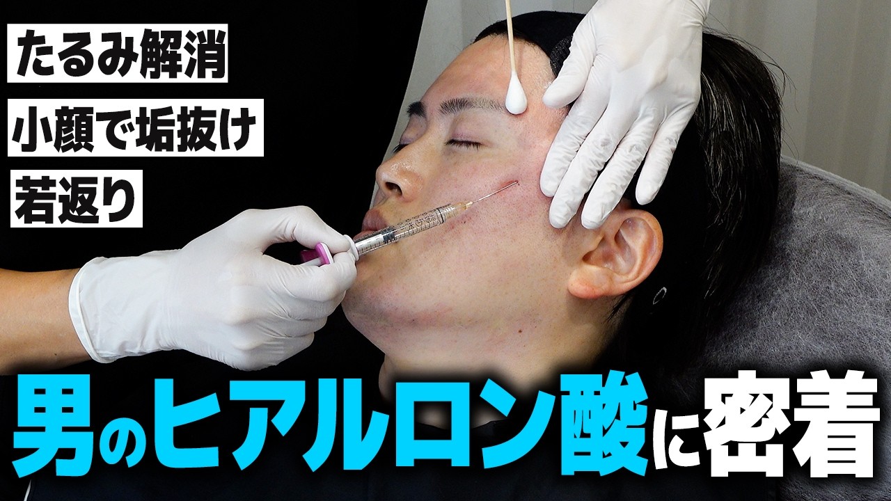 【男磨き】男性の垢抜けするヒアルロン酸治療に密着【アンチエイジング】