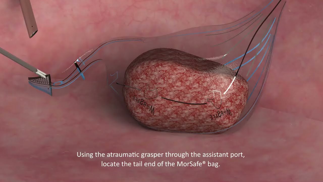 Versator Morcellator and MorSafe Bag - Contained Tissue Extraction System