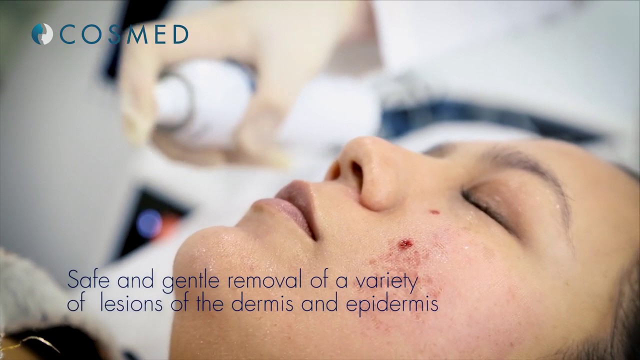 Dermablate - Laser Skin Resurfacing