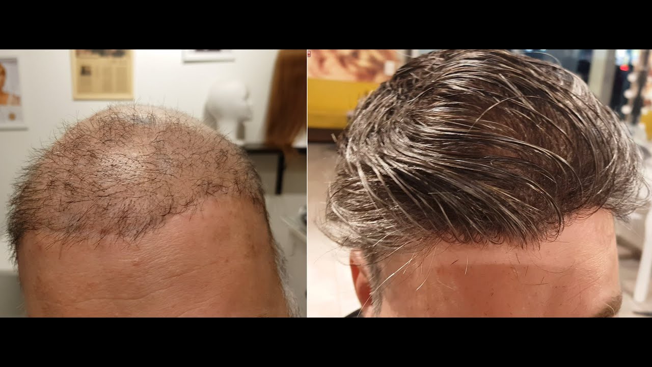 הוא רק רצה השתלת שיער בטורקיה🤧 ועשה נזק לכל החיים💀 מזל שיש Hair-me וצחי😀