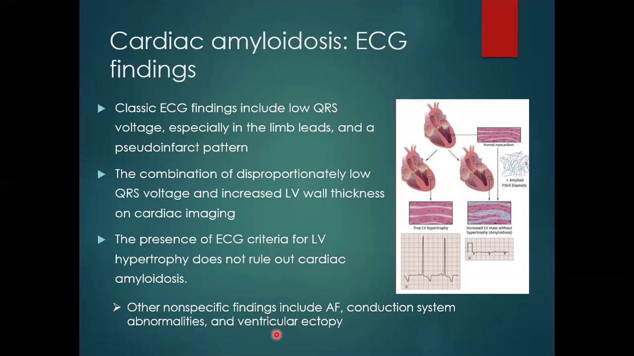 Cardiac Amyloidosis Updates