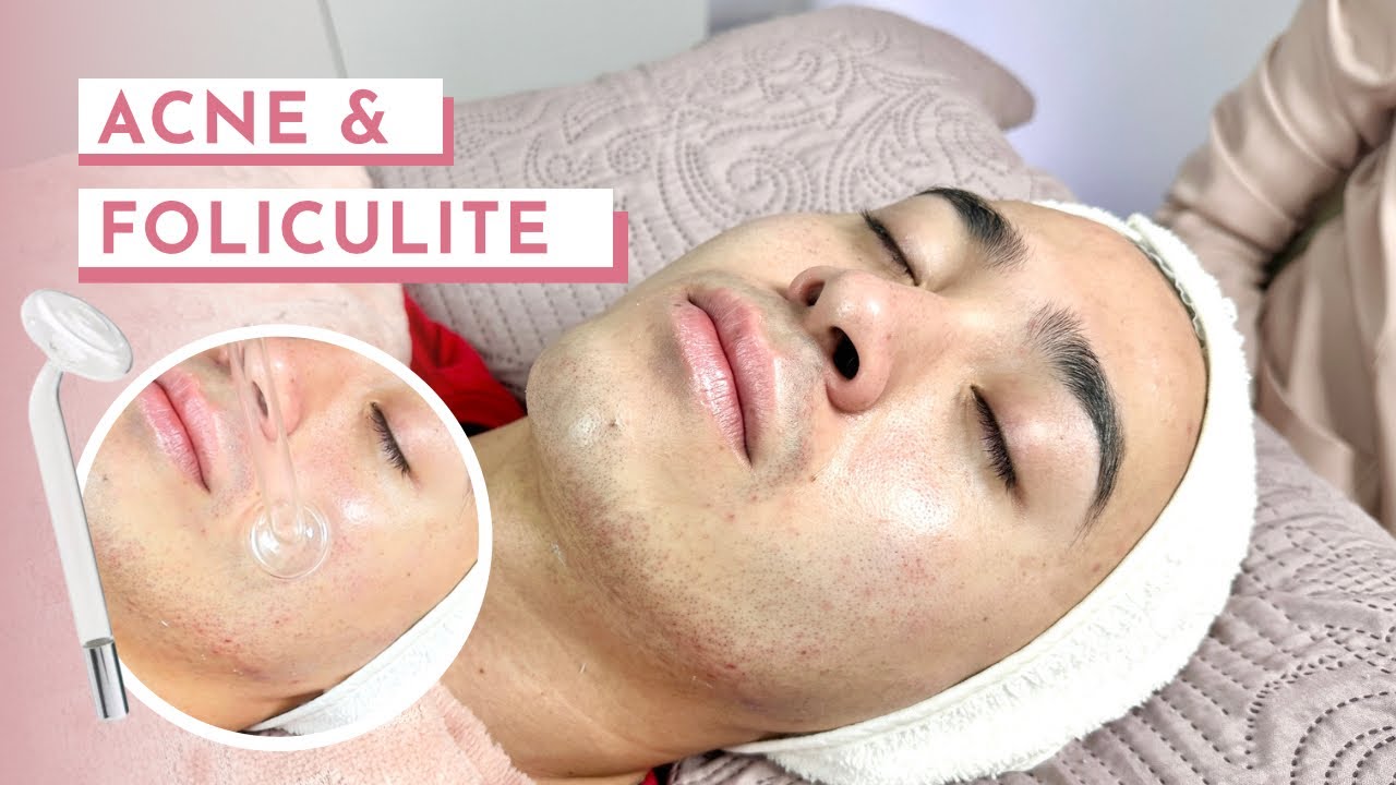 LIMPEZA DE PELE PROFISSIONAL EM PELE ACNEICA E OLEOSA