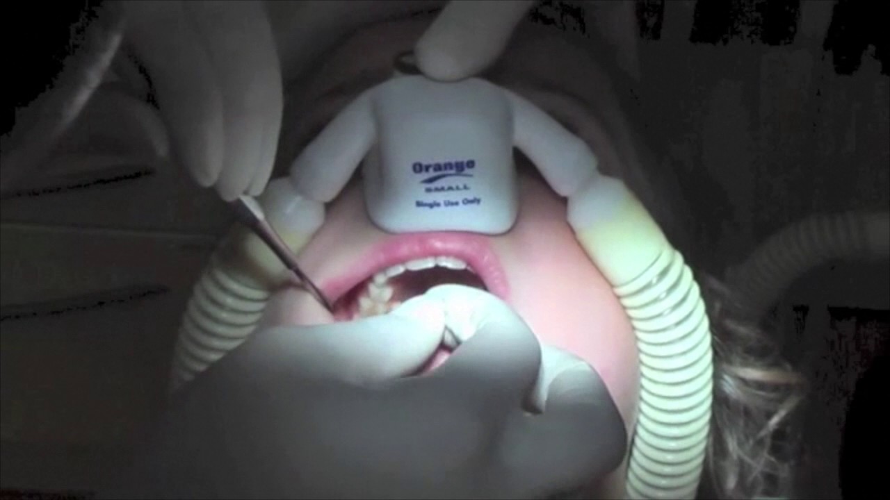 Lachgas - Behandlung- Dr. Esch