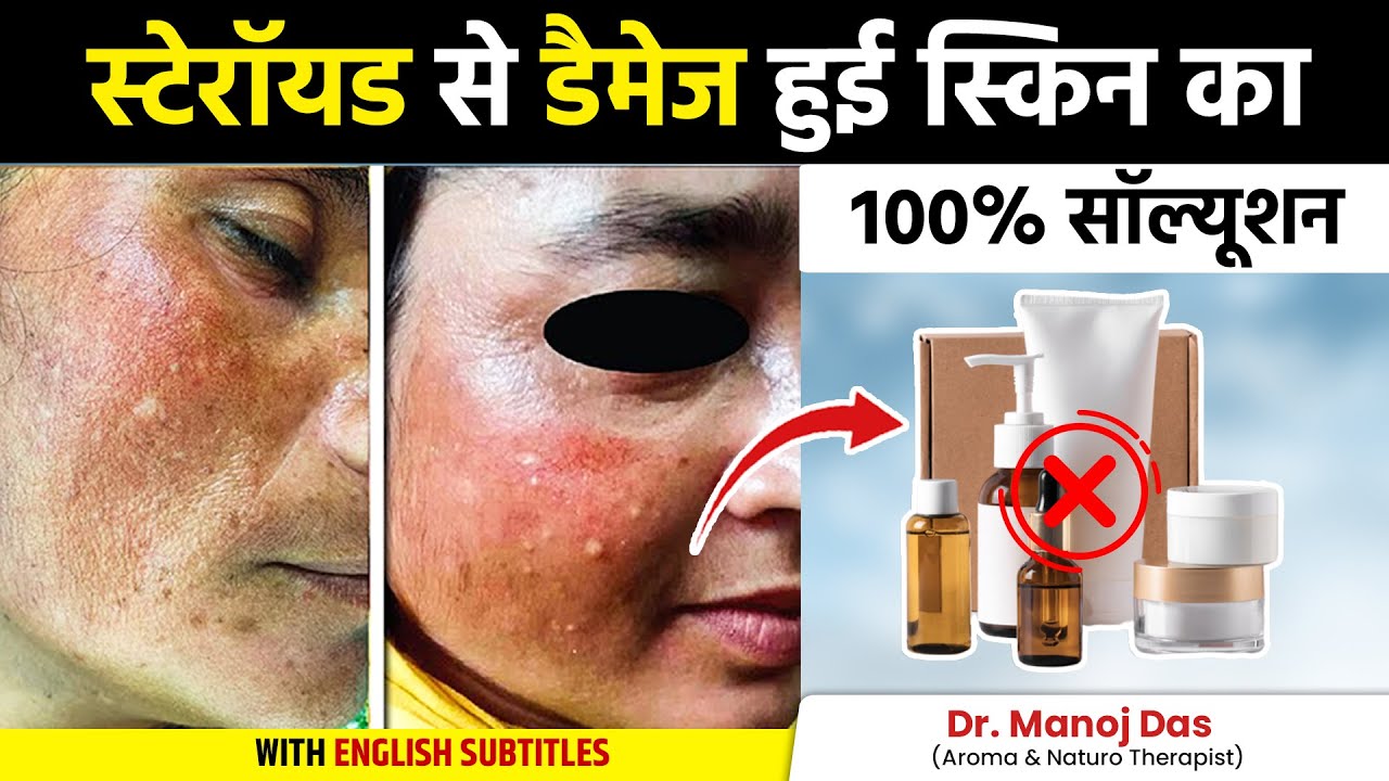 Skin Sensitivity, Allergy, Redness Treatment at Home | Steroid Skin Problems | Dr. Manoj Das