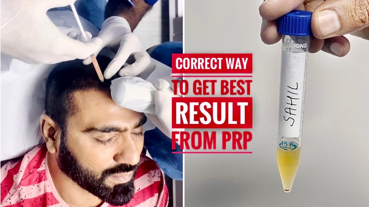 First PRP After Hair Transplant | PRP For Hair Regrowth | PRP से कुछ Patient को फ़ायदा क्यू नही होता